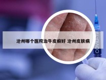 沧州哪个医院治牛皮癣好 沧州皮肤病