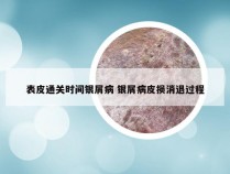 表皮通关时间银屑病 银屑病皮损消退过程