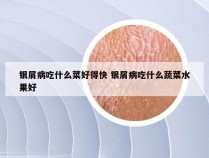 银屑病吃什么菜好得快 银屑病吃什么蔬菜水果好