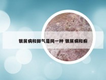 银屑病和脚气是同一种 银屑病和癣