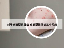 对于点滴型银屑病 点滴型银屑病三个阶段