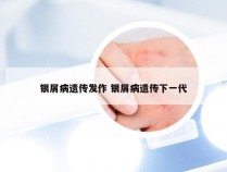 银屑病遗传发作 银屑病遗传下一代