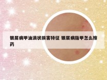 银屑病甲油滴状损害特征 银屑病指甲怎么擦药