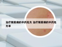 治疗银屑病的中药处方 治疗银屑病的中药处方单