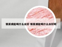 银屑病能喝什么水好 银屑病能喝什么水好呢