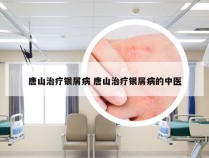 唐山治疗银屑病 唐山治疗银屑病的中医