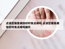 点滴型银屑病快好时有点痒吗 点滴型银屑病快好时有点痒吗图片
