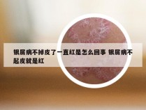 银屑病不掉皮了一直红是怎么回事 银屑病不起皮就是红