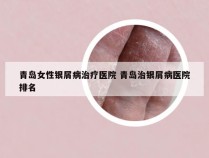 青岛女性银屑病治疗医院 青岛治银屑病医院排名