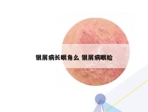 银屑病长眼角么 银屑病眼睑