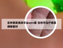 吉林银屑病来华山wen馨 吉林市治疗银屑病哪里好