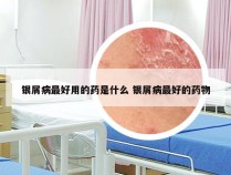 银屑病最好用的药是什么 银屑病最好的药物