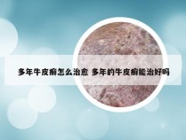 多年牛皮癣怎么治愈 多年的牛皮癣能治好吗