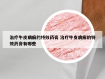 治疗牛皮病癣的特效药膏 治疗牛皮病癣的特效药膏有哪些