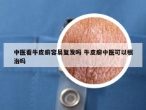 中医看牛皮癣容易复发吗 牛皮癣中医可以根治吗