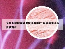 为什么银屑病刚洗完澡特别红 银屑病泡澡后皮肤变红