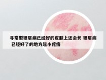 寻常型银屑病已经好的皮肤上还会长 银屑病 已经好了的地方起小疙瘩