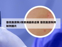 酪氨酸激酶2银屑病最新进展 酪氨酸激酶抑制剂图片