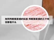 如何判断银屑病的标准 判断银屑病的三个特征都是什么