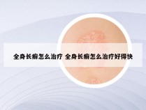 全身长癣怎么治疗 全身长癣怎么治疗好得快