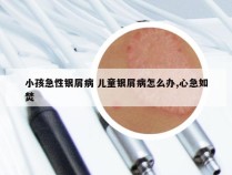 小孩急性银屑病 儿童银屑病怎么办,心急如焚
