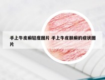 手上牛皮癣轻度图片 手上牛皮肤癣的症状图片