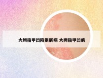 大姆指甲凹陷银屑病 大拇指甲凹痕
