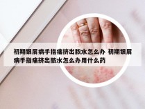 初期银屑病手指痛挤出脓水怎么办 初期银屑病手指痛挤出脓水怎么办用什么药