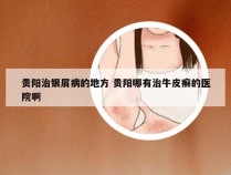 贵阳治银屑病的地方 贵阳哪有治牛皮癣的医院啊