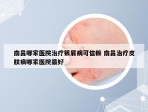南昌哪家医院治疗银屑病可信赖 南昌治疗皮肤病哪家医院最好