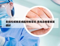 贵阳权威银屑病医院哪家好 贵阳去哪看银屑病好