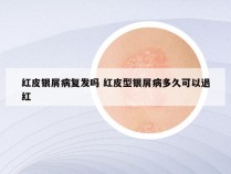 红皮银屑病复发吗 红皮型银屑病多久可以退红