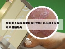 郑州哪个医院看银屑病比较好 郑州那个医院看银屑病最好