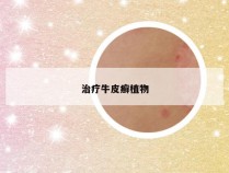 治疗牛皮癣植物