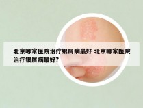北京哪家医院治疗银屑病最好 北京哪家医院治疗银屑病最好?