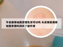 牛皮癣用哈西奈德乳膏可以吗 头皮银屑病用哈西奈德时间长了副作用