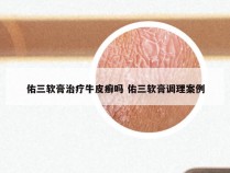 佑三软膏治疗牛皮癣吗 佑三软膏调理案例