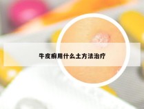 牛皮癣用什么土方法治疗