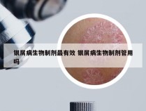 银屑病生物制剂最有效 银屑病生物制剂管用吗