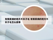 有银屑病的地方不长汗毛 有银屑病的地方不长汗毛怎么回事