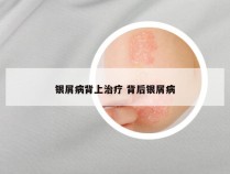 银屑病背上治疗 背后银屑病