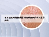 银屑病夏天药物减量 银屑病夏天药物减量会好吗