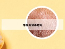 牛皮癣算毒疮吗