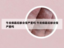 牛皮癣最后都会变严重吗 牛皮癣最后都会变严重吗