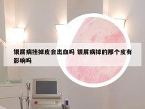 银屑病挂掉皮会出血吗 银屑病掉的那个皮有影响吗