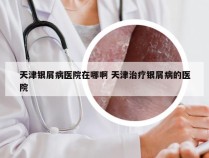 天津银屑病医院在哪啊 天津治疗银屑病的医院