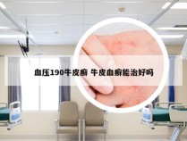 血压190牛皮癣 牛皮血癣能治好吗