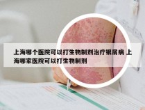 上海哪个医院可以打生物制剂治疗银屑病 上海哪家医院可以打生物制剂
