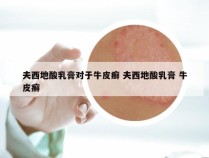 夫西地酸乳膏对于牛皮癣 夫西地酸乳膏 牛皮癣