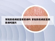 掌跖脓疱病就是银屑病吗 掌跖脓疱病就是银屑病吗图片